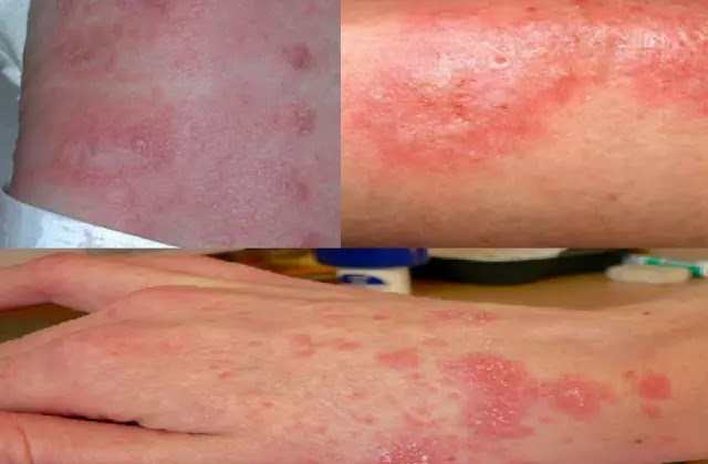 খোস-পাঁচড়া ও চুলকানি