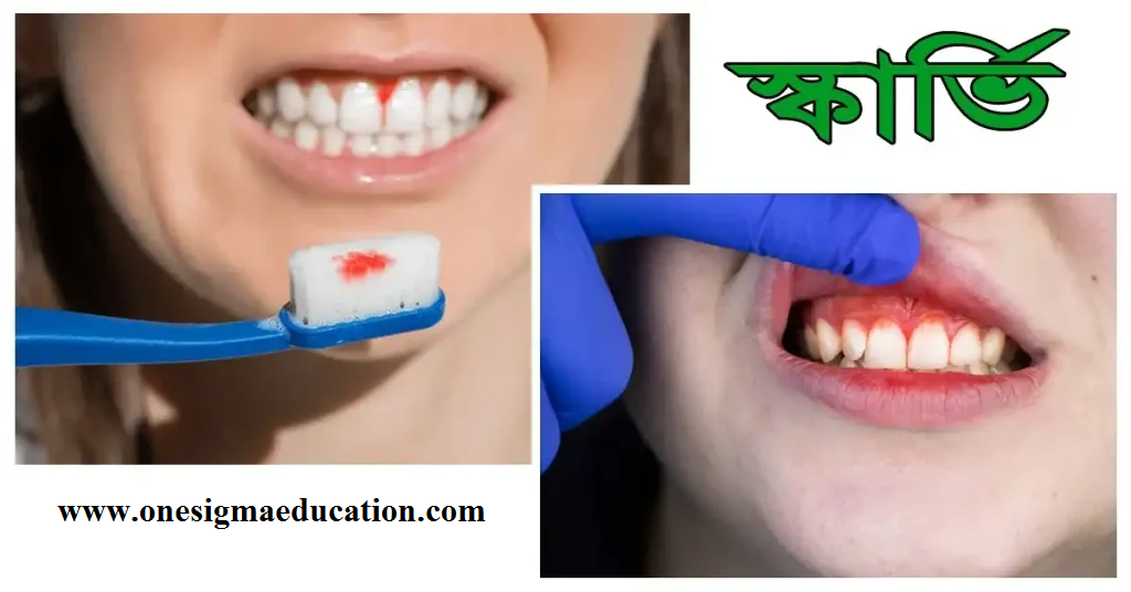 স্কার্ভি রোগ